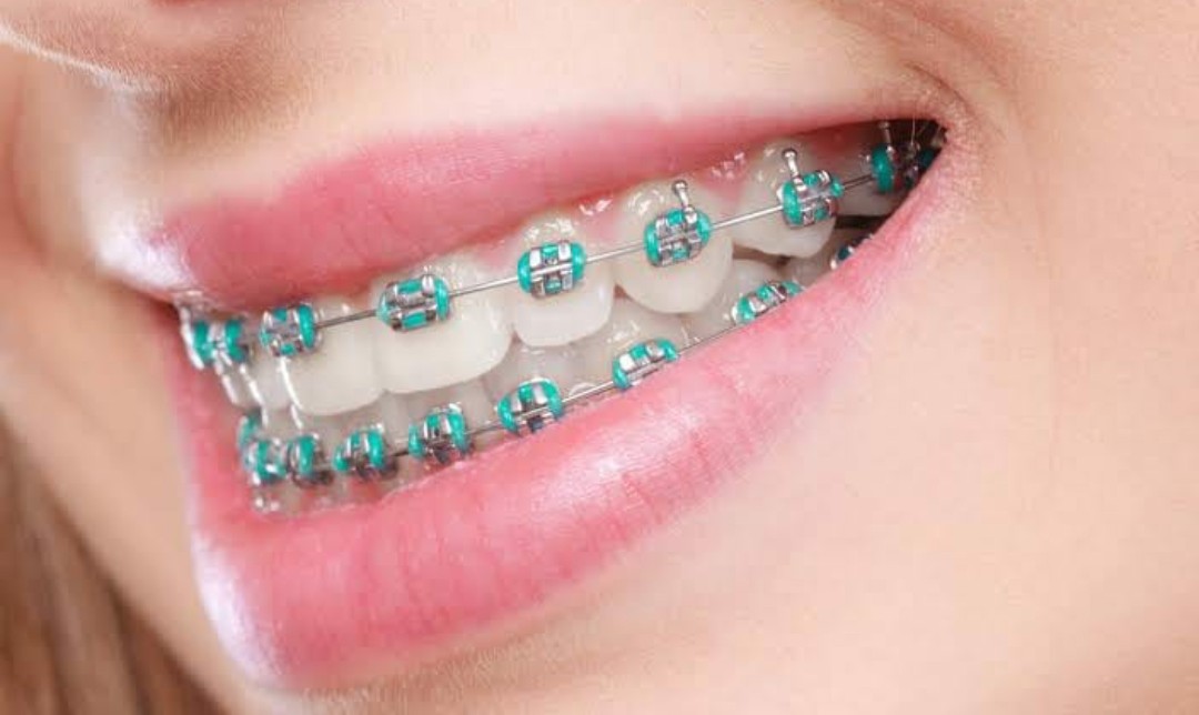 Close-up of orthodontic braces on teeth