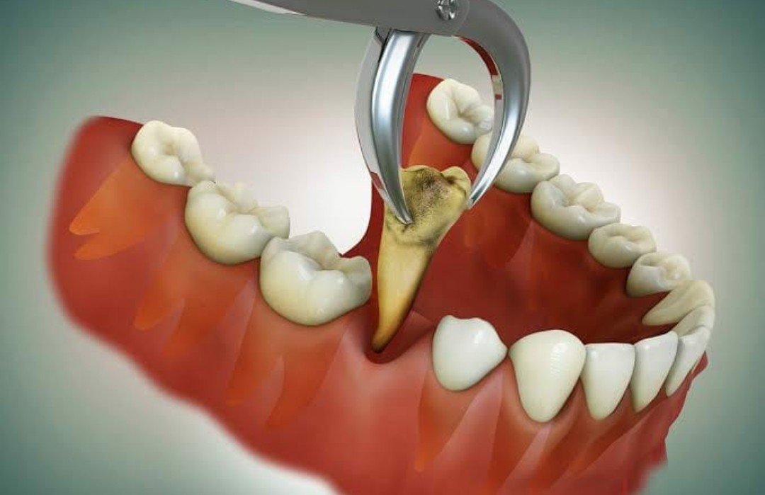 Tooth extraction procedure