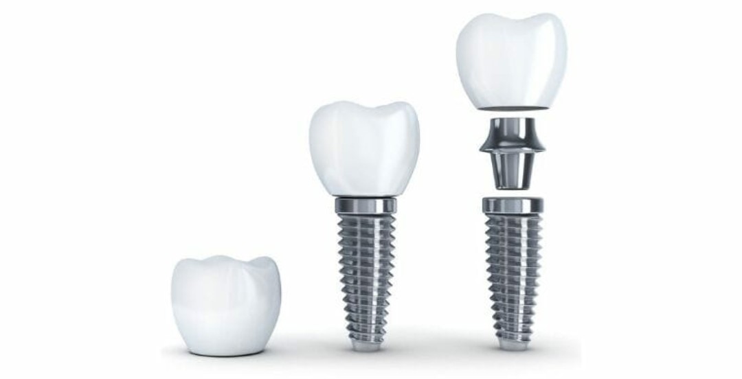 Dental implant, abutment and crown components